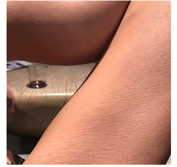 katir holmes vergétures