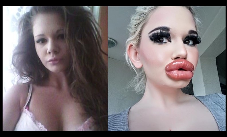 étudiante chirurgie lèvres