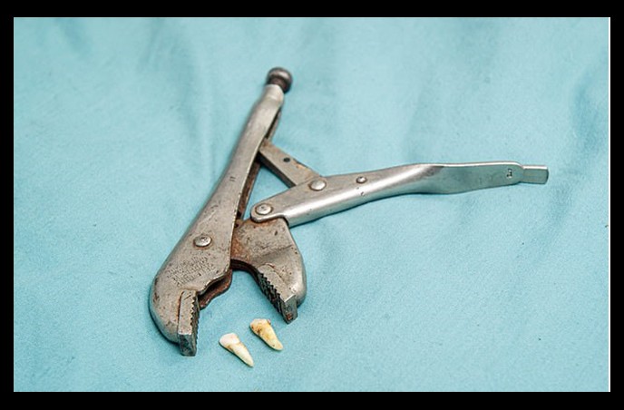 Sans rendez-vous à cause du covid...il s'arrache 2 dents à la pince 1 dents