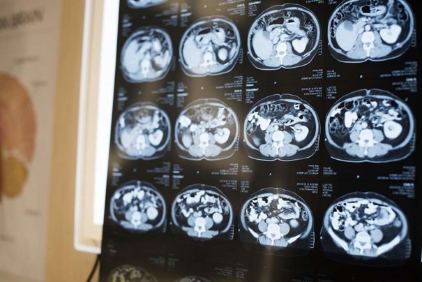 On découvre un ver qui se promène dans son cerveau 1 cerveau