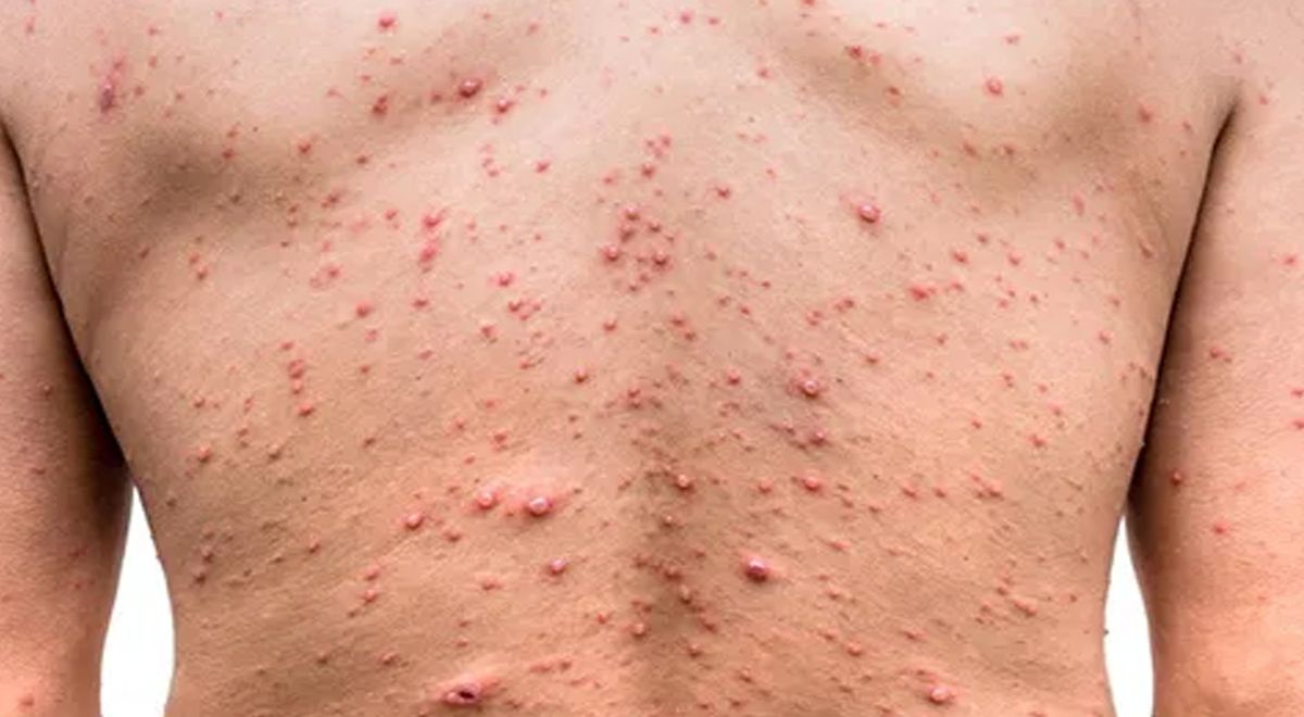 33 cas de Variole du singe «confirmés» en France