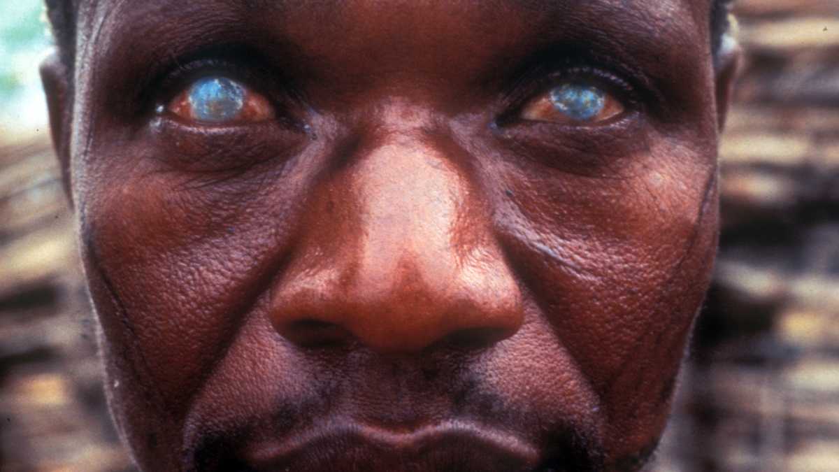 Onchocercose : Le Sénégal franchit une étape majeure vers l’élimination de la maladie 10 Onchocercose : Le Sénégal franchit une étape majeure vers l’élimination de la maladie